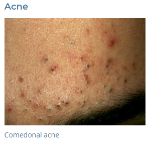 Acne / Acne Scars 212SKIn Dermatology