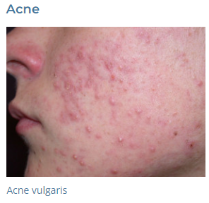Acne / Acne Scars 212SKIn Dermatology