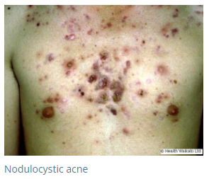 Acne / Acne Scars 212SKIn Dermatology