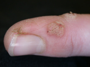Common warts (verruca vulgaris)